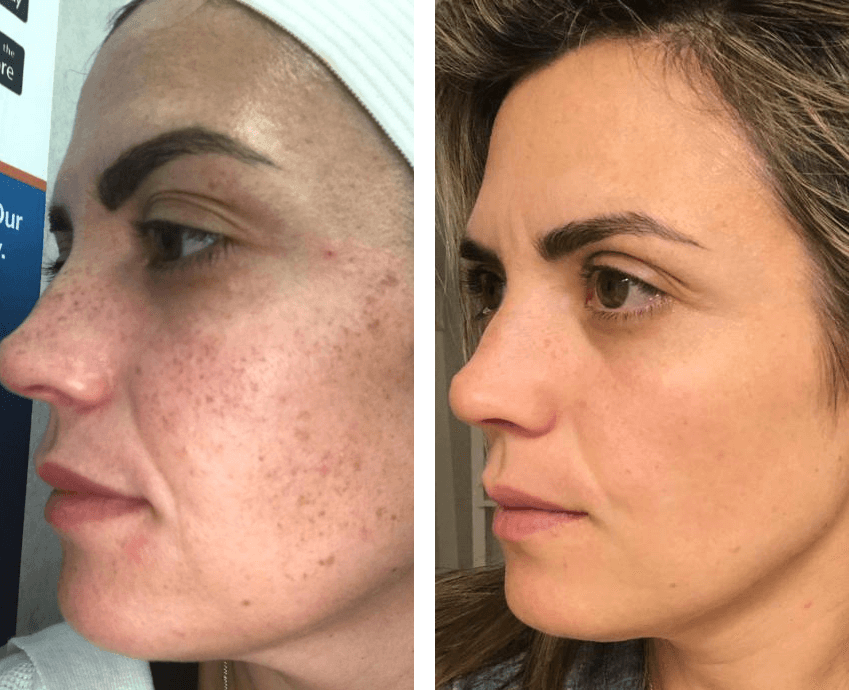 IPL before and after skin rejuvenation results - Core IV Aesthetic Services Herndon, VA