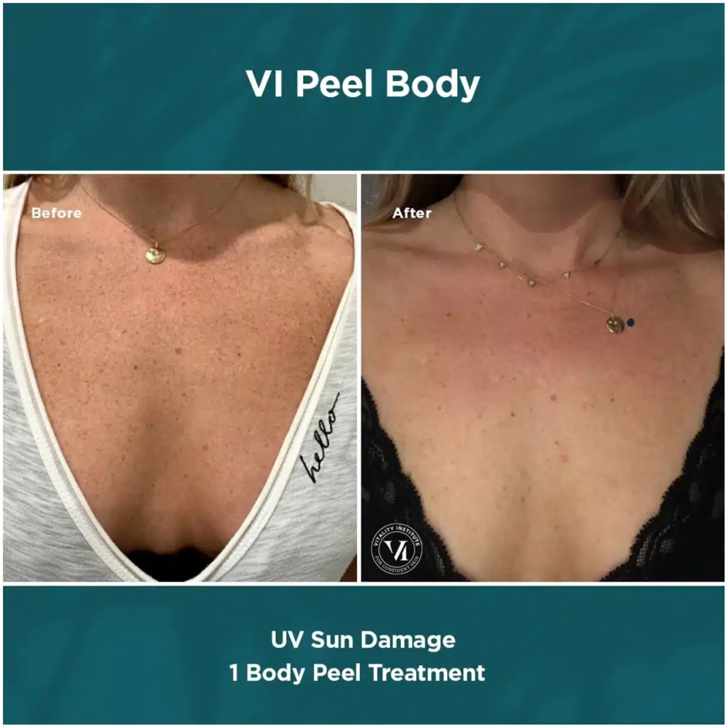 VI Peel medical-grade chemical peel - Core IV Aesthetic Services Herndon, VA
