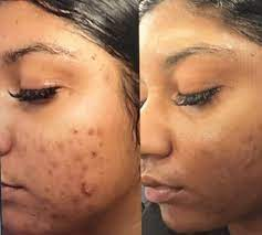 VI Peel medical-grade chemical peel - Core IV Aesthetic Services Herndon, VA