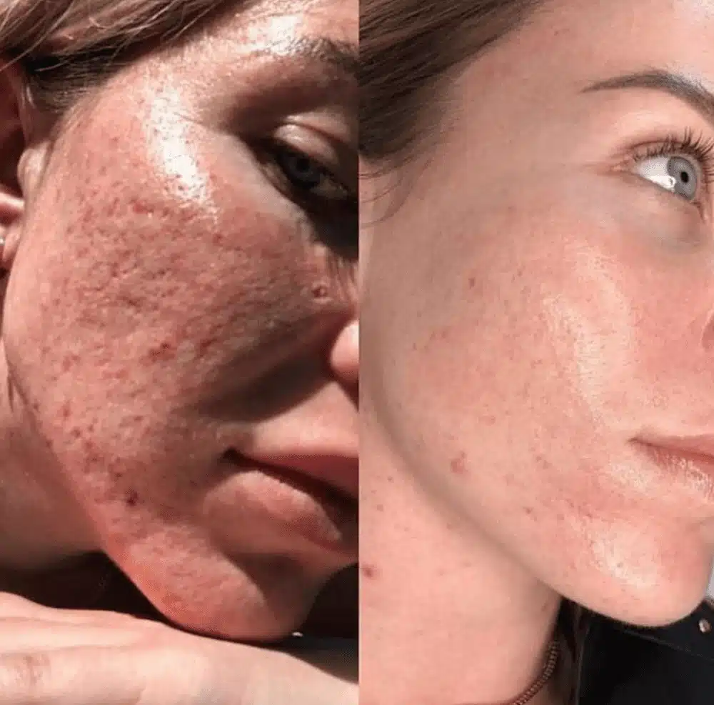Venus Viva skin resurfacing treatment - Core IV Aesthetic Services Herndon, VA