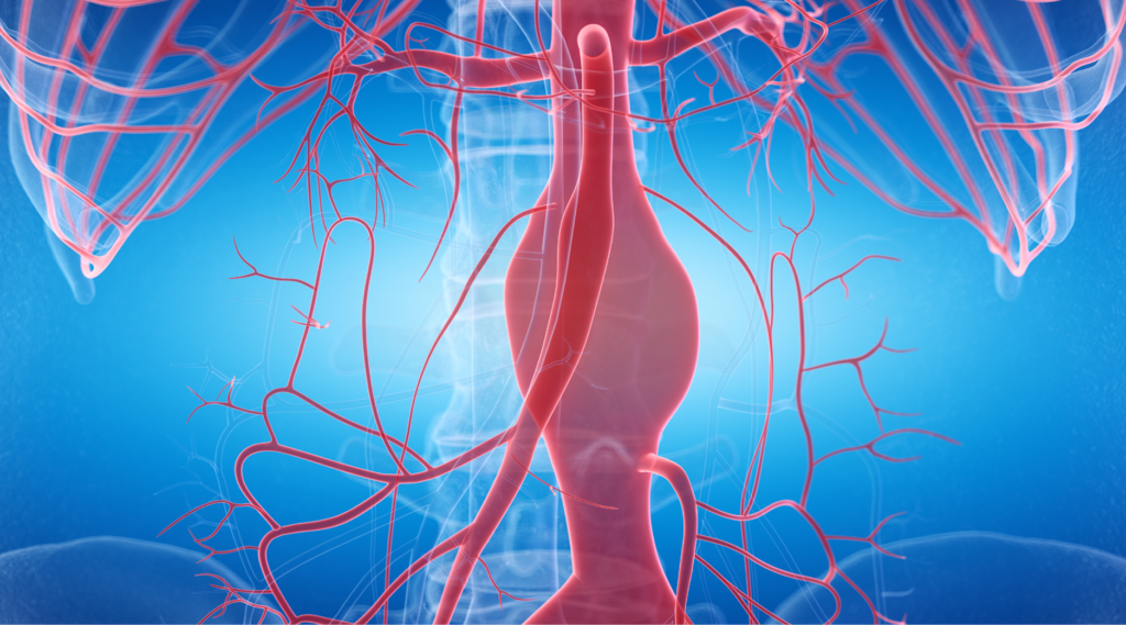 3d rendered medically accurate illustration of an aneurysm