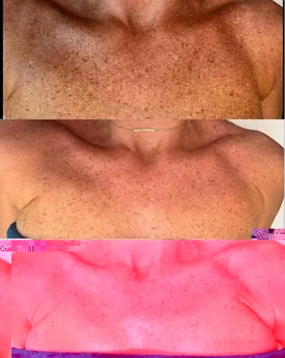 Chest before and after VI Peel treatment for sun damage and hyperpigmentation at Core iV Therapy in Herndon, VA